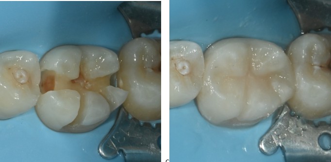 충치 치료 재료 선택, 레진·인레이·크라운 중 내 치아에 맞는 건 어떻게 결정되나요?